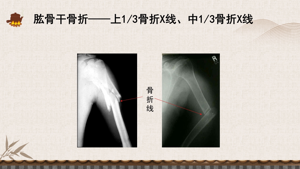 中医伤科上肢骨折护理查房PPT课件49