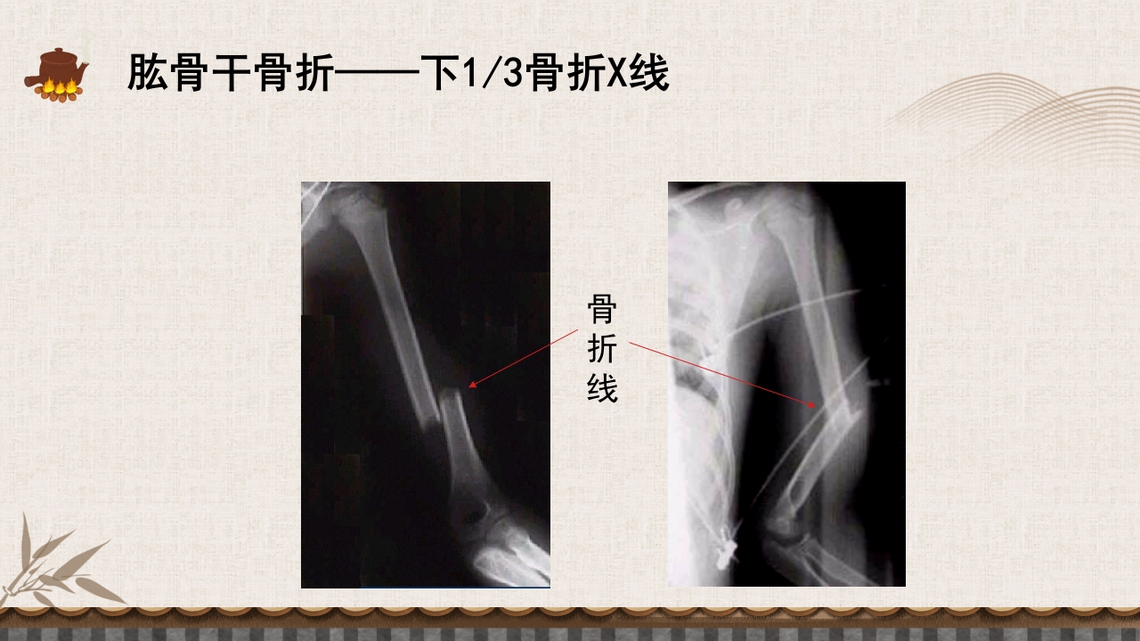 中医伤科上肢骨折护理查房PPT课件50