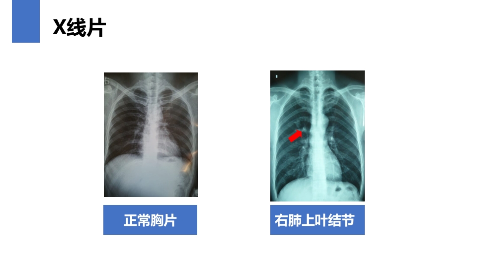 肺癌的早期诊断与防治PPT课件26