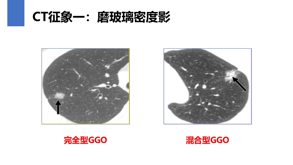 肺癌的早期诊断与防治PPT课件31