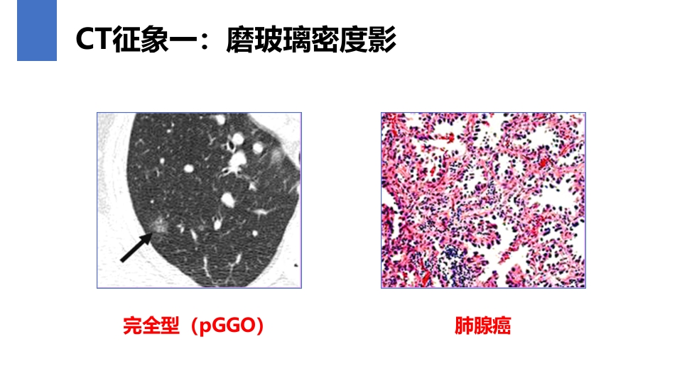 肺癌的早期诊断与防治PPT课件32