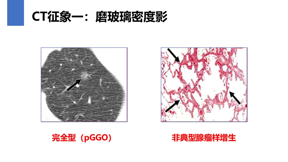 肺癌的早期诊断与防治PPT课件33