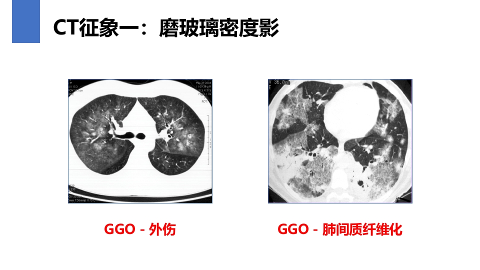 肺癌的早期诊断与防治PPT课件34