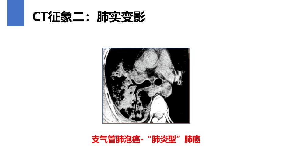 肺癌的早期诊断与防治PPT课件36