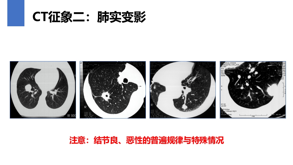 肺癌的早期诊断与防治PPT课件41