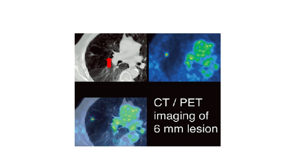 肺癌的早期诊断与防治PPT课件44