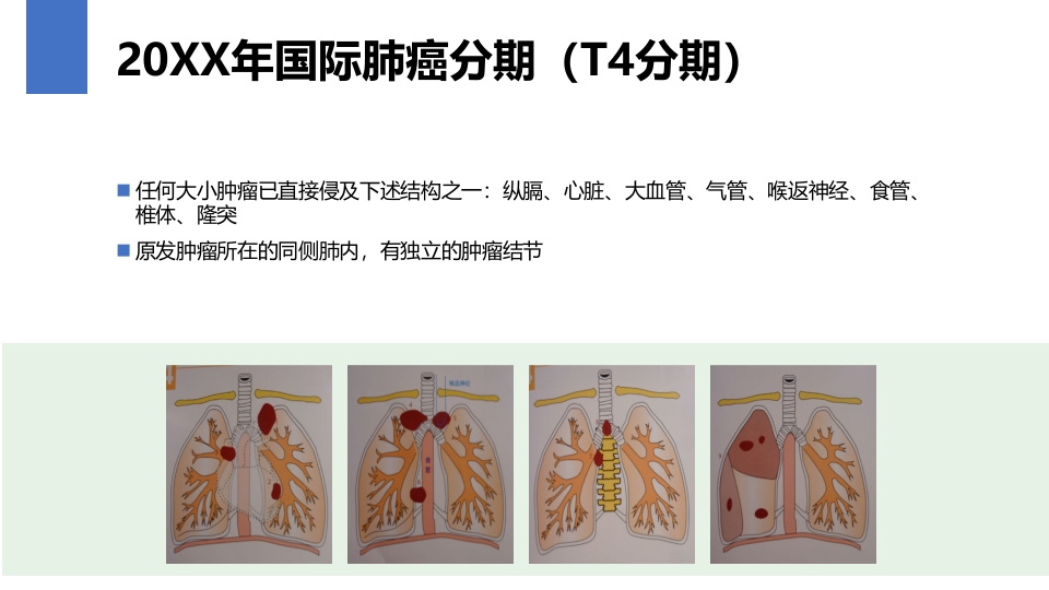 肺癌的早期诊断与防治PPT课件48