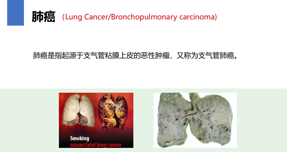 肺癌的早期诊断与防治PPT课件5