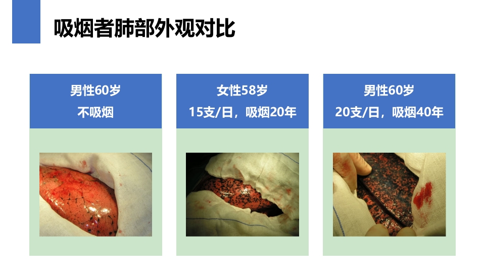 肺癌的早期诊断与防治PPT课件9