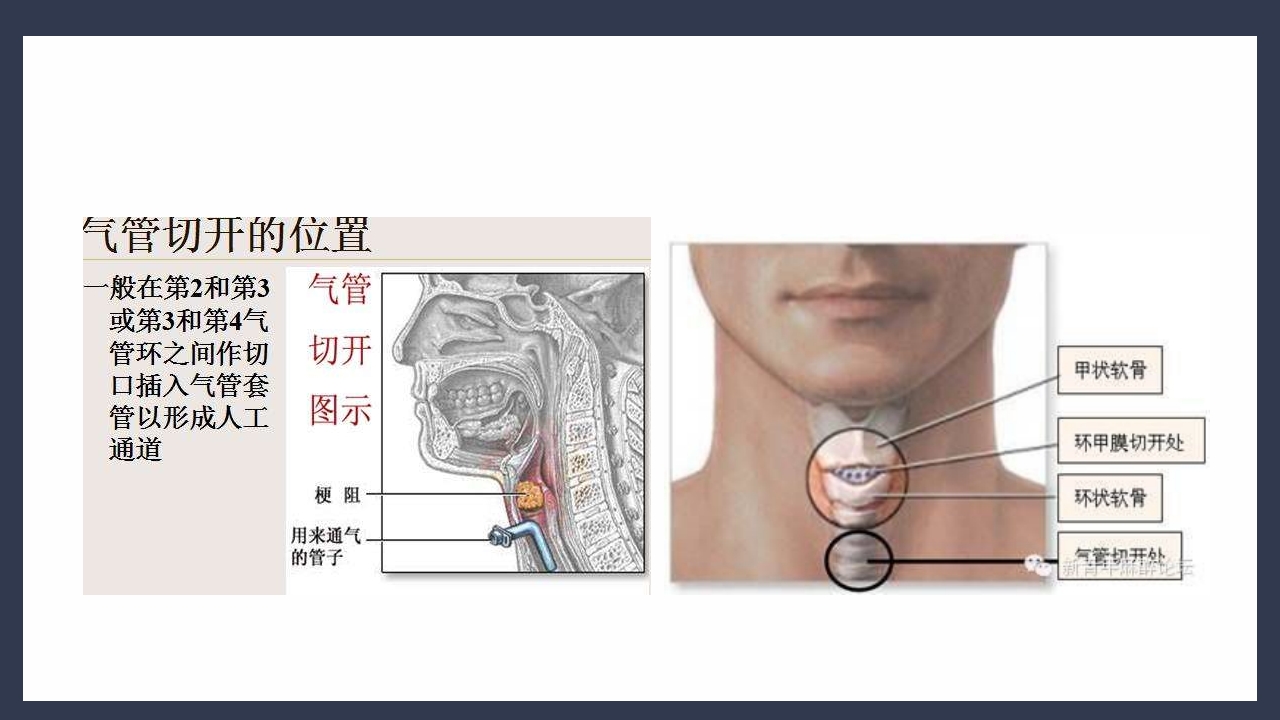 气管切开术后患者护理查房PPT课件12