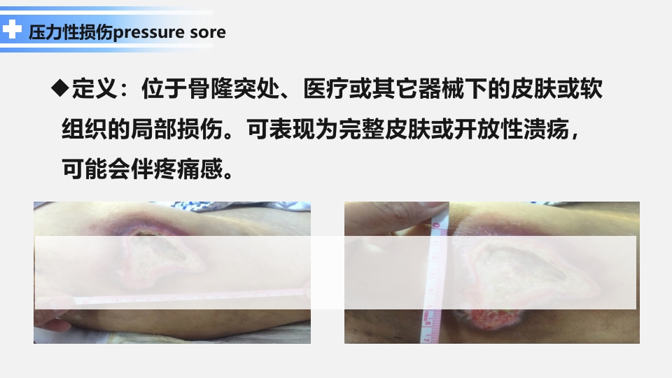 卧床病人常见并发症及护理要点ppt课件4