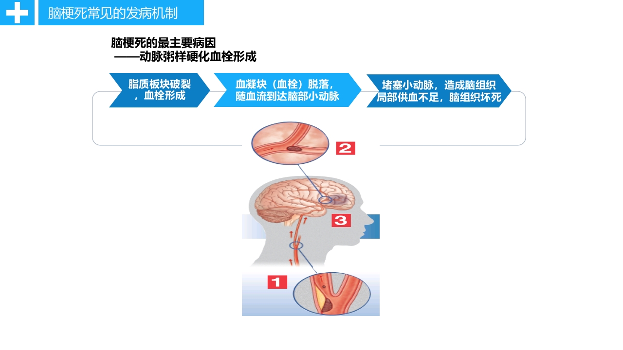 急性脑卒中静脉溶栓病人的护理PPT课件10