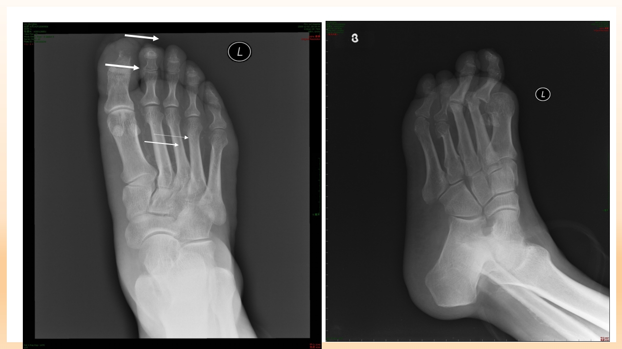 糖尿病足治疗与护理PPT课件32