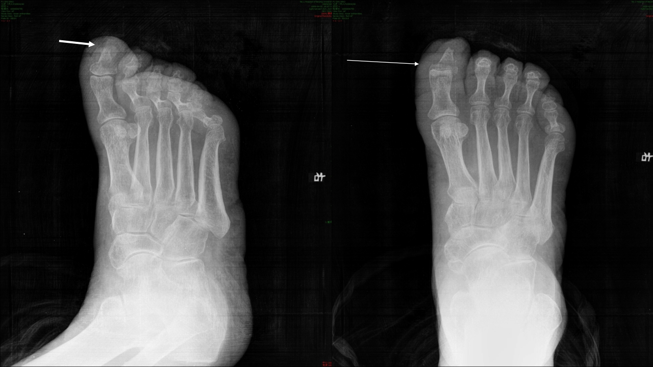 糖尿病足治疗与护理PPT课件33