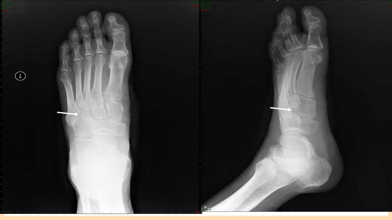 糖尿病足治疗与护理PPT课件34