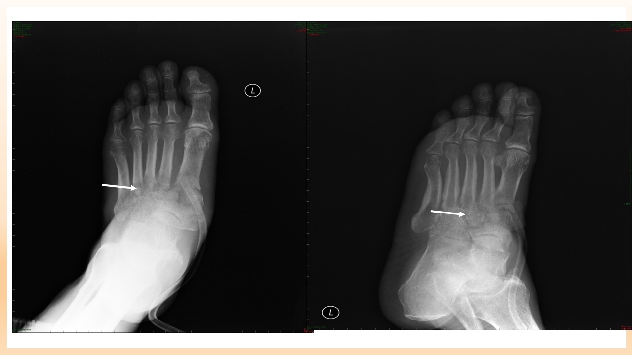 糖尿病足治疗与护理PPT课件35