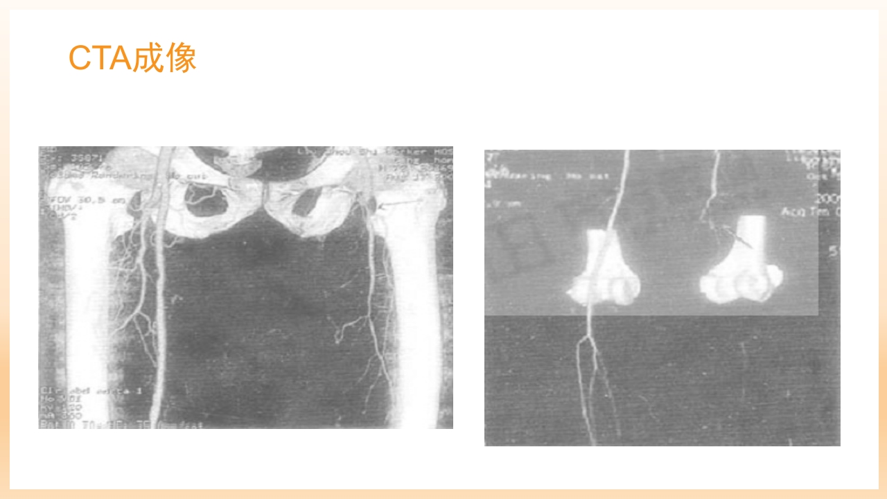糖尿病足治疗与护理PPT课件37
