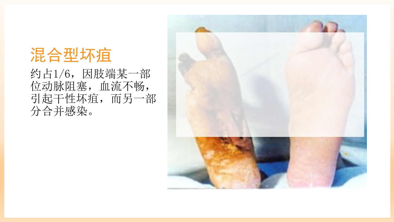 糖尿病足治疗与护理PPT课件49