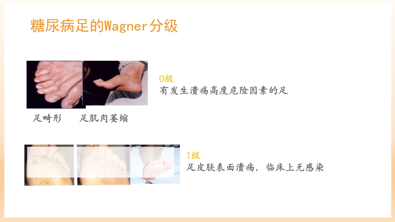 糖尿病足治疗与护理PPT课件51