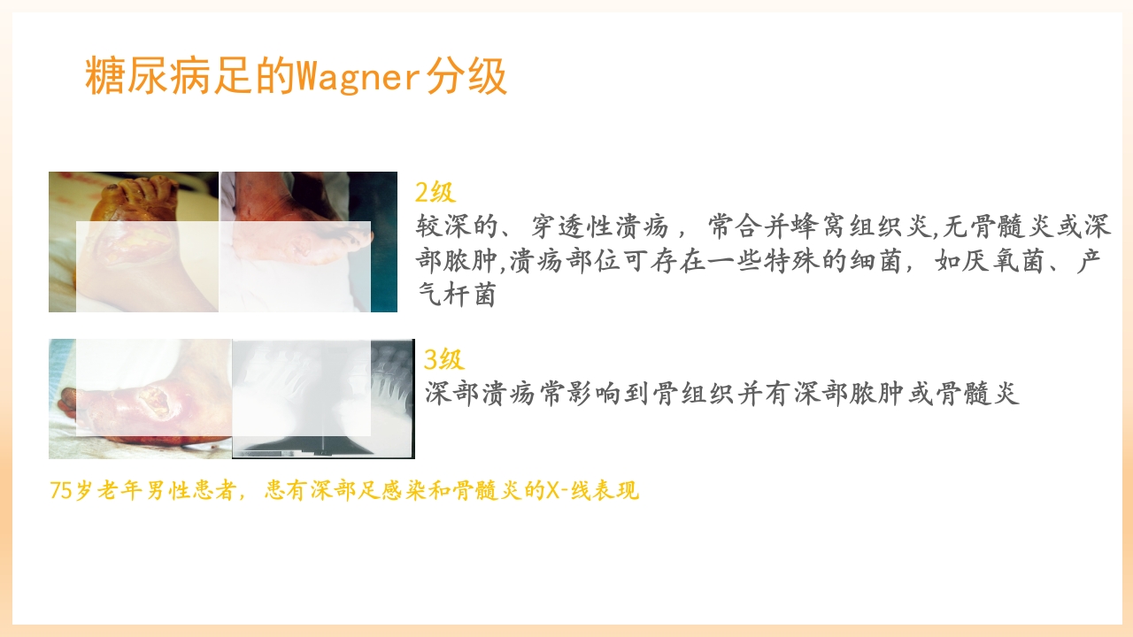 糖尿病足治疗与护理PPT课件52