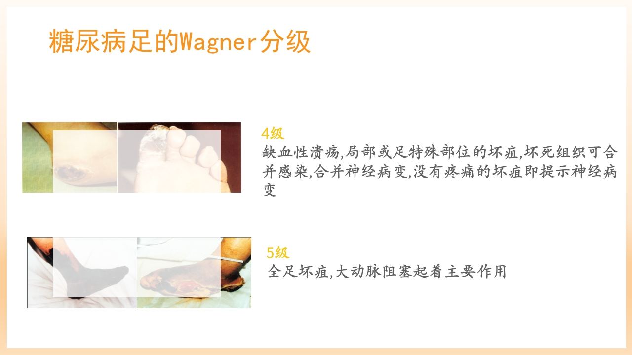 糖尿病足治疗与护理PPT课件53