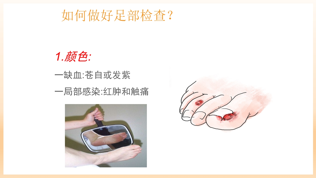 糖尿病足治疗与护理PPT课件65