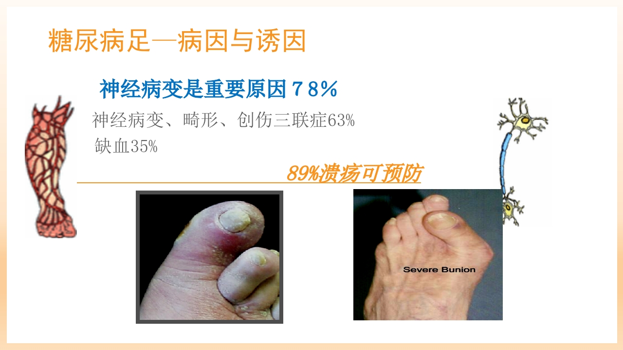 糖尿病足治疗与护理PPT课件9