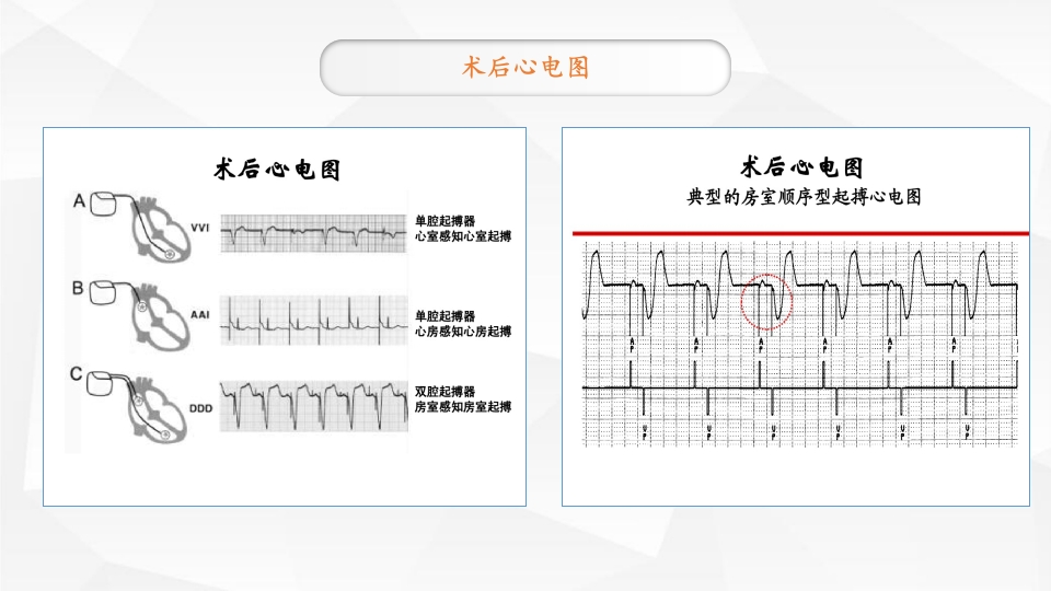 永久性心脏起搏器置入术ppt课件10