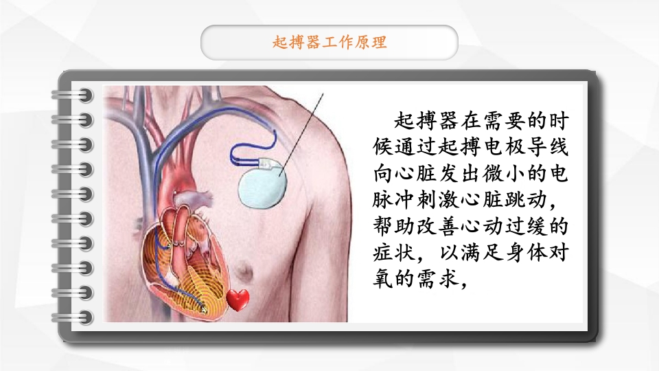 永久性心脏起搏器置入术ppt课件4
