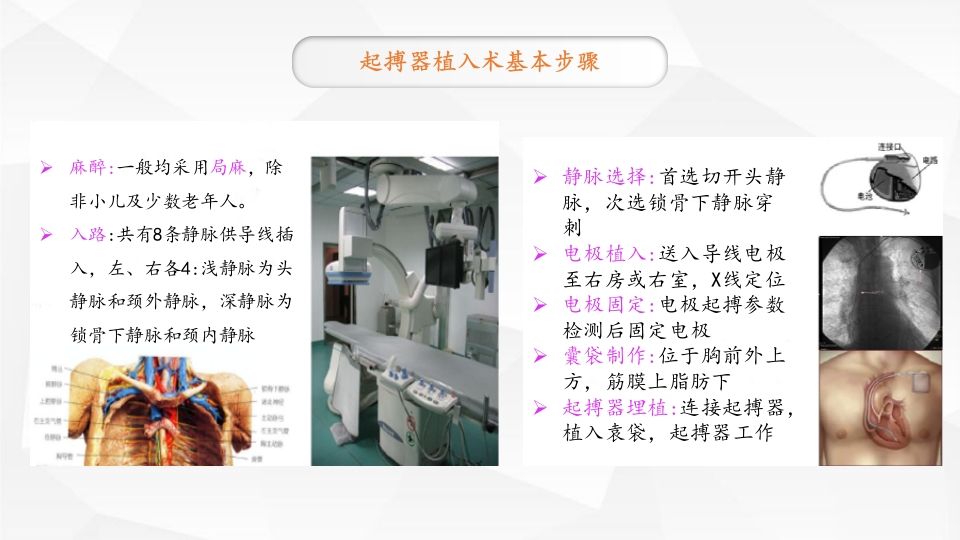 永久性心脏起搏器置入术ppt课件8