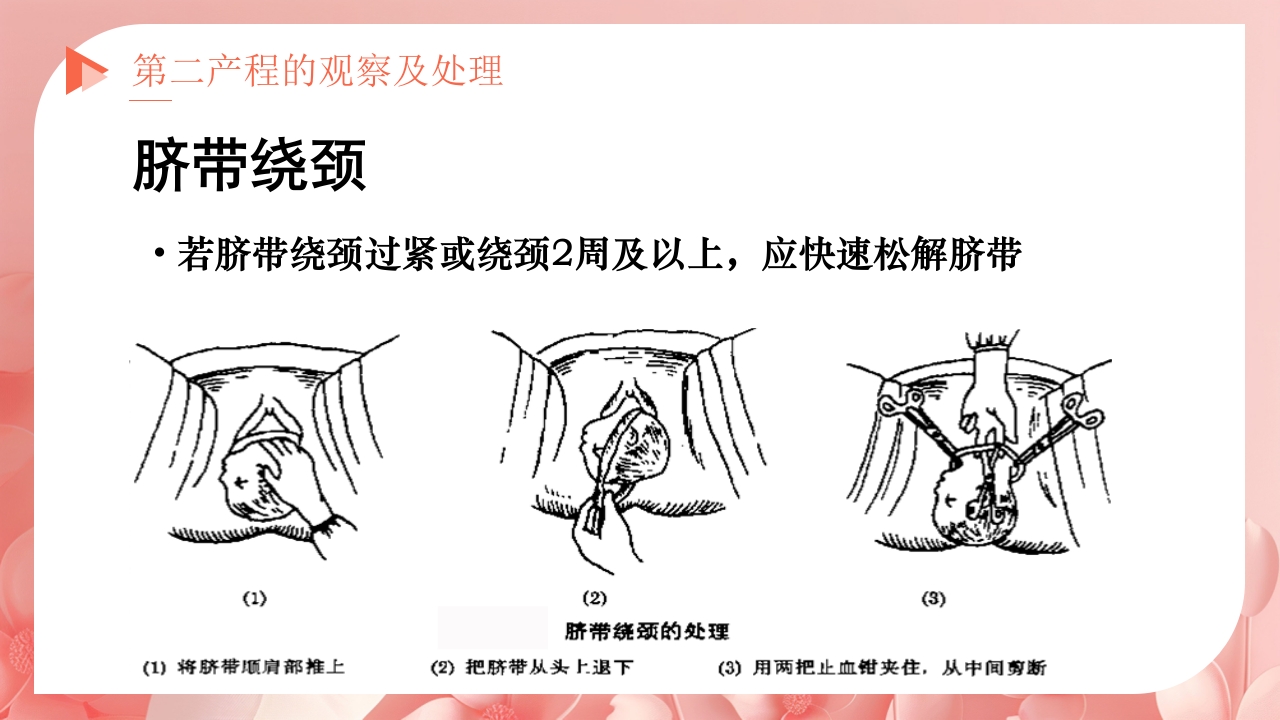 产程的观察及处理ppt课件21