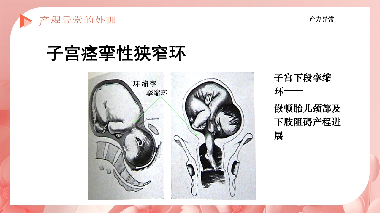 产程的观察及处理ppt课件42