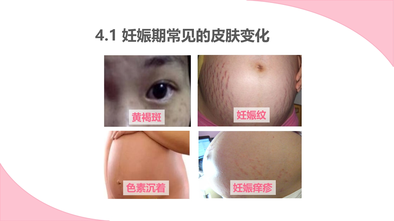 孕期常见不适及处理方法ppt课件22