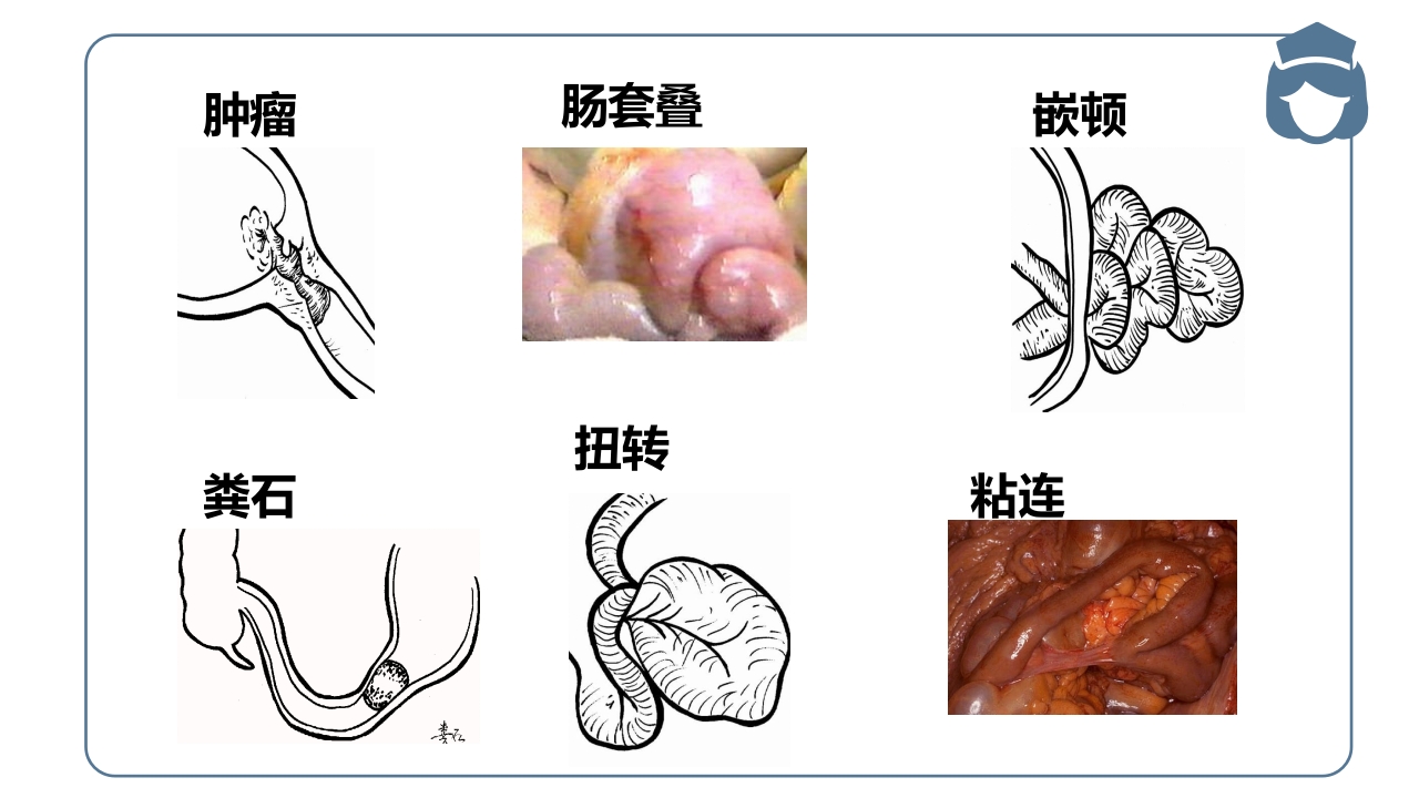 肠梗阻病人的护理PPT课件7