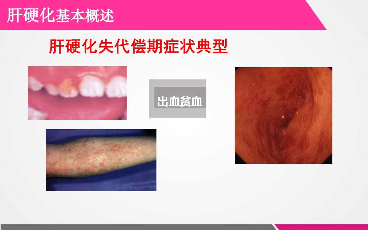 肝硬化失代偿期患者的护理查房ppt课件5