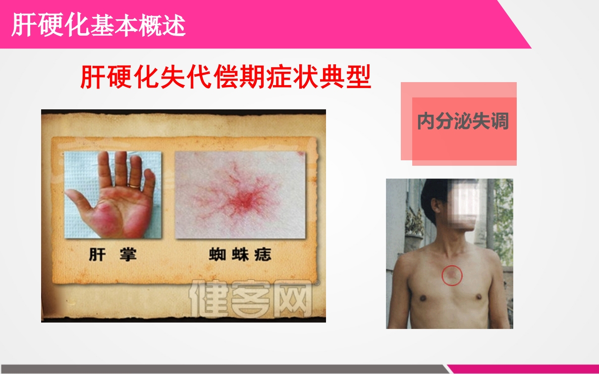 肝硬化失代偿期患者的护理查房ppt课件6