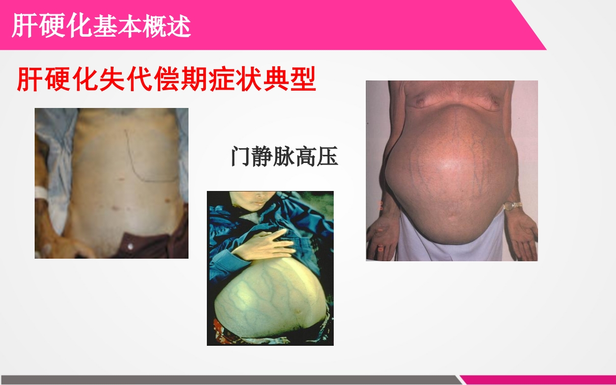 肝硬化失代偿期患者的护理查房ppt课件7