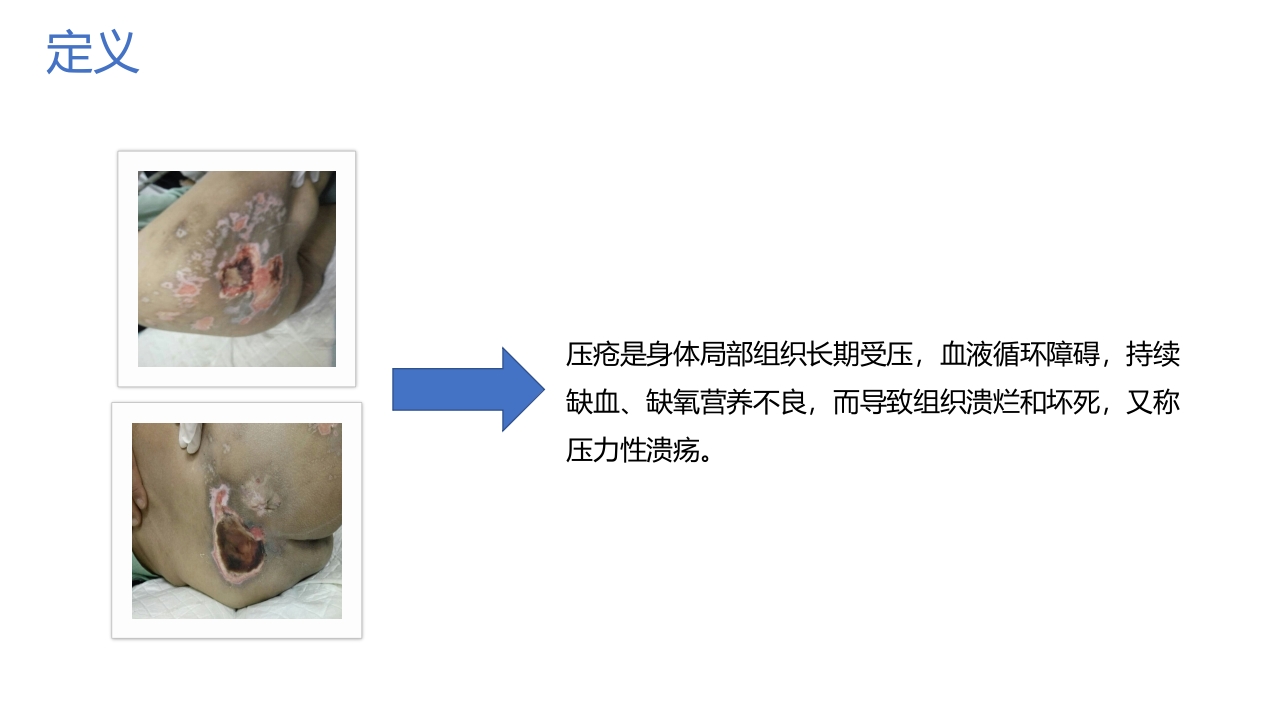 重度压疮患者的护理查房PPT课件4
