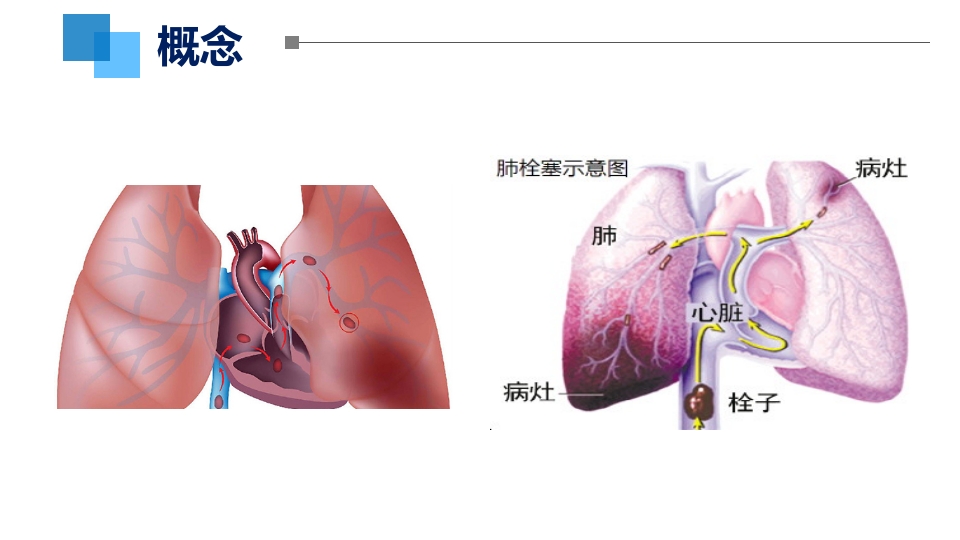 VTE的评估与预防ppt课件7