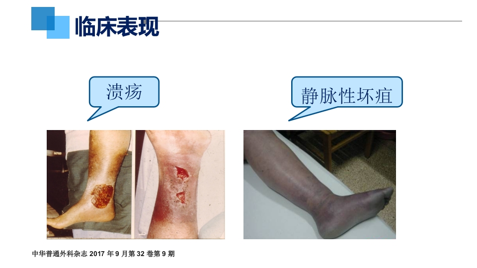 VTE的预防和护理措施ppt课件10