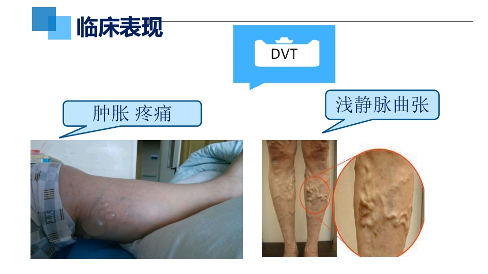 VTE的预防和护理措施ppt课件9
