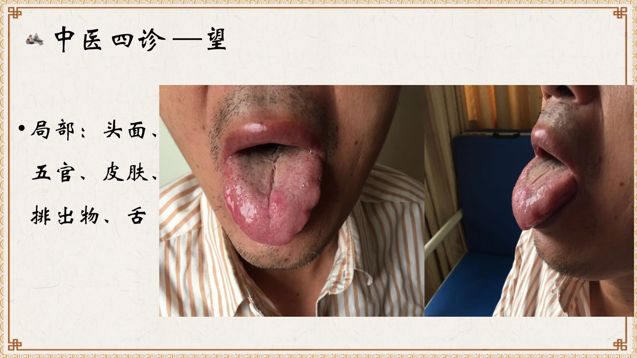 平衡火罐在腰痛病患者的运用ppt课件7