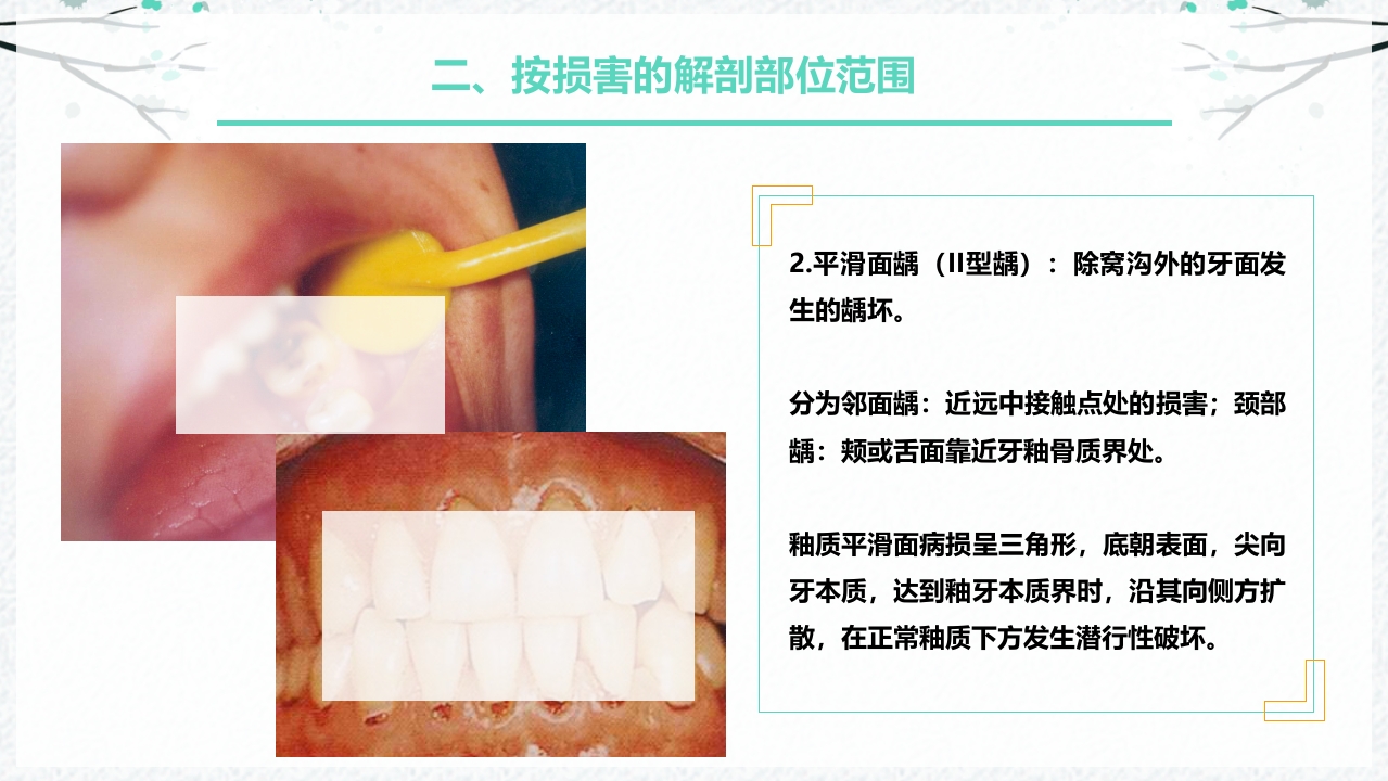 龋病的分类及充填治疗ppt课件7