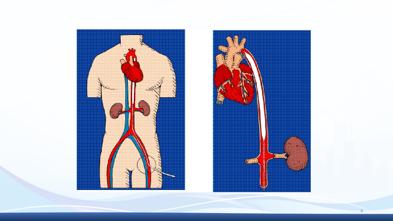 主动脉球囊反搏术(IABP)监测及护理ppt课件4