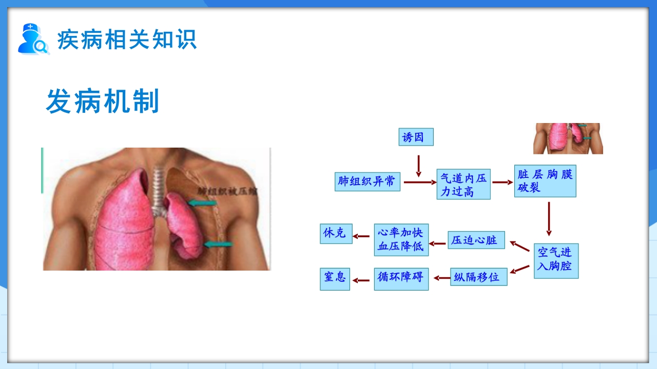 自发性气胸护理查房PPT课件5