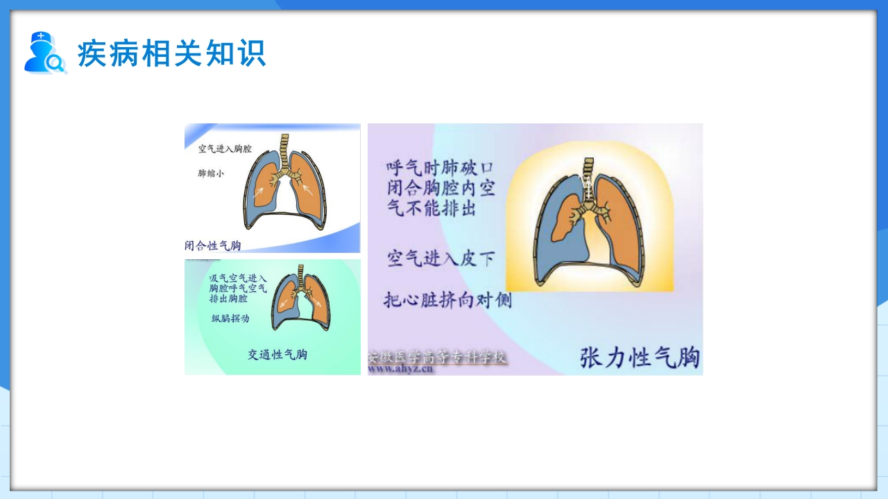 自发性气胸护理查房PPT课件8