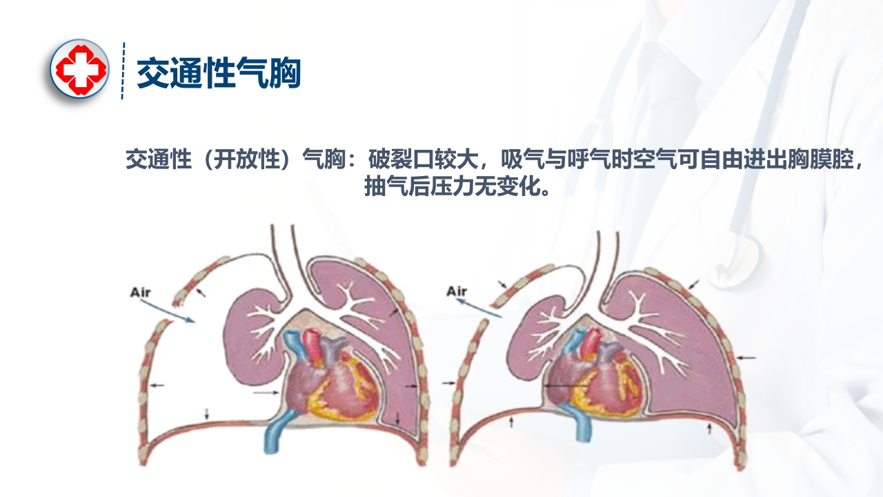 气胸的诊断及治疗ppt课件8