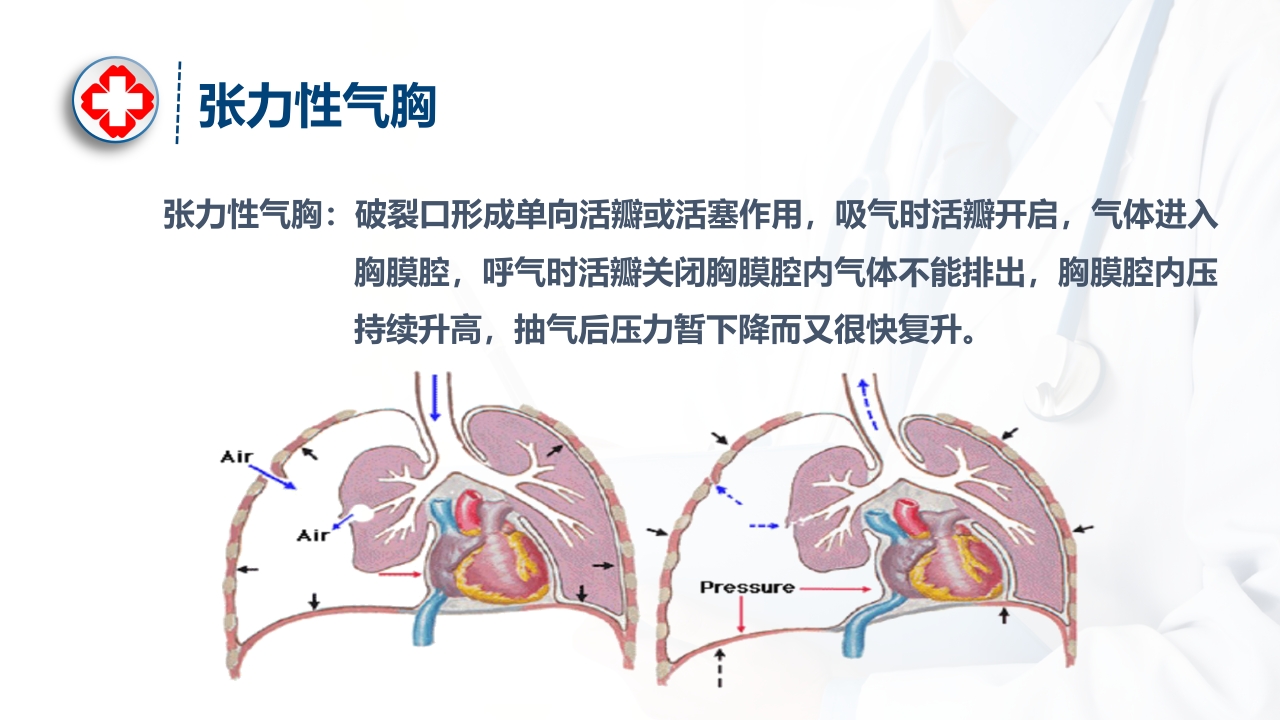 气胸的诊断及治疗ppt课件9