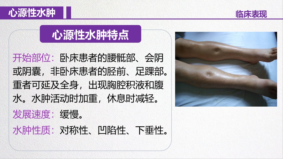 水源性水肿病人的护理PPT课件6