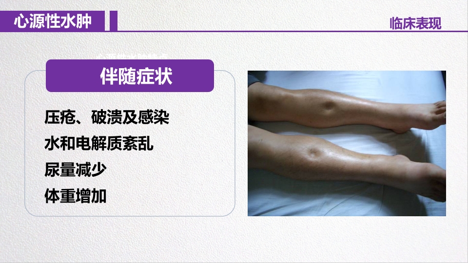 水源性水肿病人的护理PPT课件7